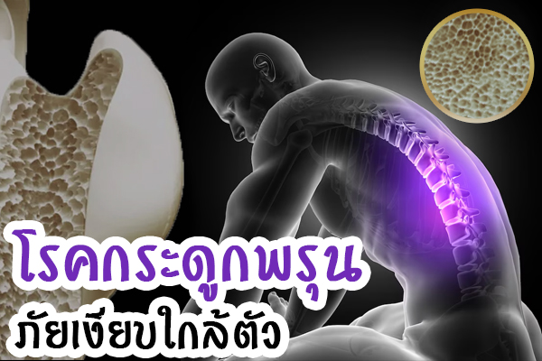 โรคกระดูกพรุน โรคกระดูกพรุน